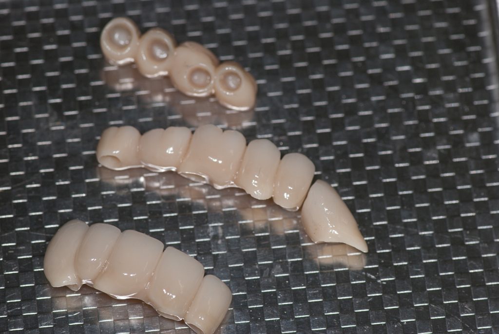 metallfreie Zirkonbrücken für minimalinvasive Zahnimplantate