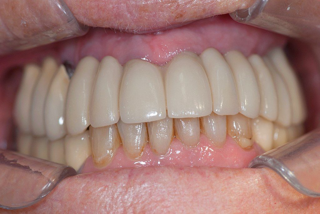 Zahnimplantat Reinigung unter Zahnersatz Prothese